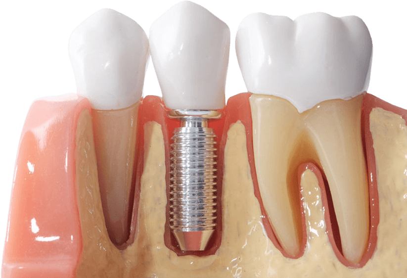 implanty stomatologiczne gdynia